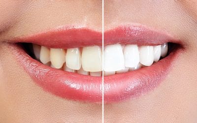 Natural Teeth Whitening: Expert Tips for Whiter Teeth