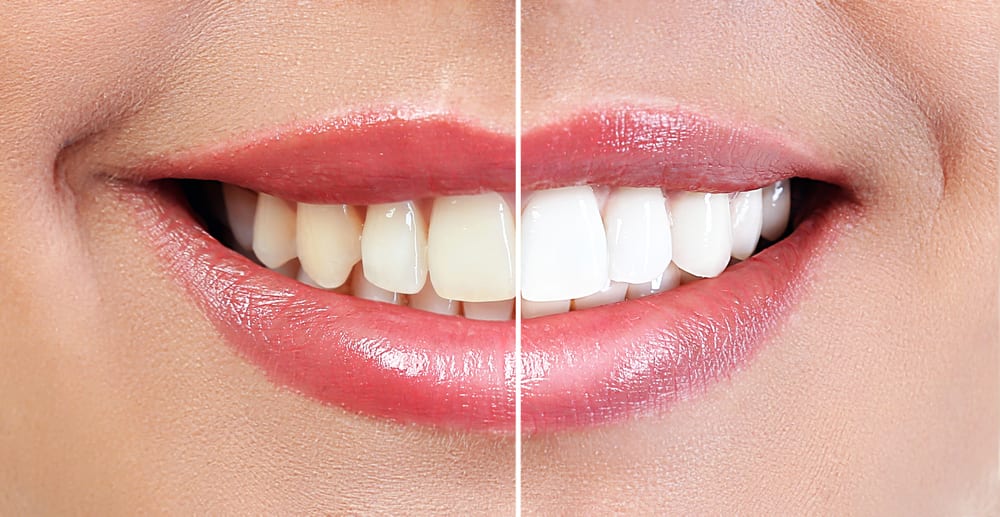 before & after teeth whitening smile