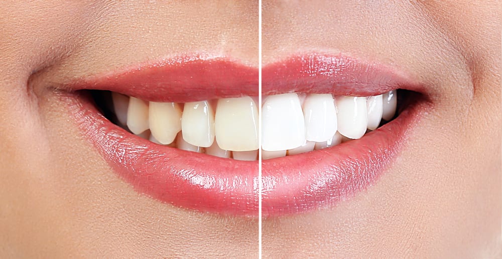 Natural Teeth Whitening: Expert Tips for Whiter Teeth